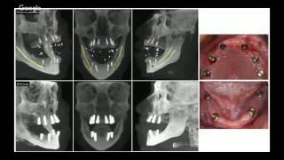 Digital Smile Design Integration With Blue Sky Plan Dr Marko Tadros [upl. by Attehcram]