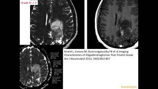 63 Oligodendroglioma 1p19q codeleted IDHmutant corticalsubcortical mass oligoastrocytoma [upl. by Raffo87]