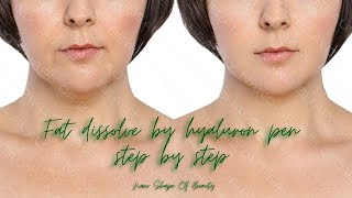 Fat dissolve by hyaluron pen step by step [upl. by Clarita]