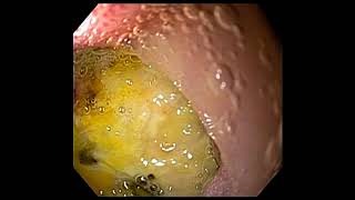 Duodenal ulcer [upl. by Morganne894]