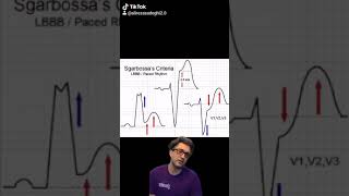 sgarbossa criteria made easy [upl. by Hugibert199]