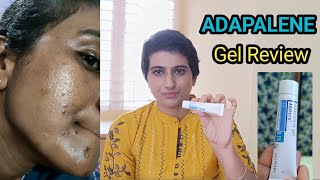 adapalene gel review telugu  adaferin gel for acne commedones and acne marks How to use adapalene [upl. by Salakcin]