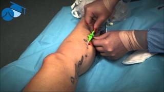 Multiple cannulation of complex recurrent varicose veins [upl. by Colon]