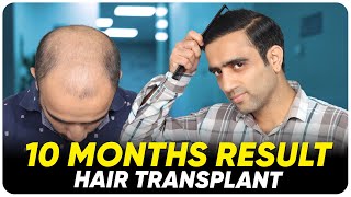 Hair Transplant in Hyderabad  Best Results amp Cost of Hair Transplant in Hyderabad [upl. by Anilrac687]