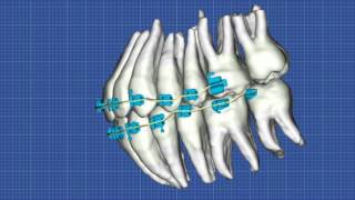 Suresmile Wires Movie [upl. by Aynekat]