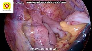 STEPS OF LAPAROSCOPIC HYSTERECTOMY SHARING OUR EXPERIENCES DR AVINASH SHAHARE DR SHWETA SHAHARE [upl. by Macdonell]