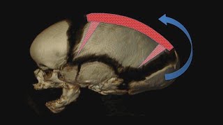 What is Sagittal Craniosynostosis [upl. by Ayekat667]