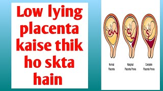 low lying placenta कैसे ठीक हो सकता है low lying placenta risk and precautions [upl. by Sine958]