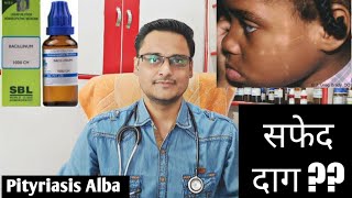 Pityriasis alba homeopathic treatment  explain चेहरे पर सफेद दाग [upl. by Giacopo]