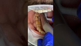 Filling cavity with 3D printed filling dentist cavities oralhealth filling [upl. by Adiehsar]