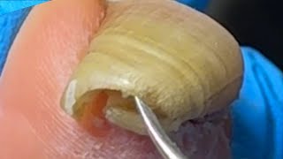 Extremely long ingrown toenailsThe patient has not had a pedicure for 4 months【Xue Yidao】 [upl. by Launam]