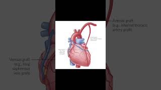 CABGCoronary artery bypass grafting [upl. by Doone954]