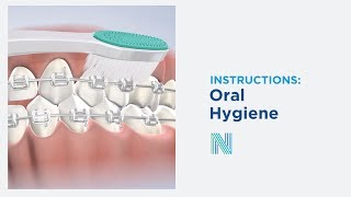 Oral Hygiene Care Instructions in Fresno CA  Nalchajian Orthodontics [upl. by Olly]