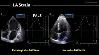 〖Echocardiography〗 Myocarditis  from HFrEF to heart transplant 💕 [upl. by Olivann]