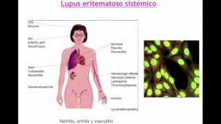 umh1947 201213 Lec001 Otras enfermedades de base autoinmune I [upl. by Petulia426]