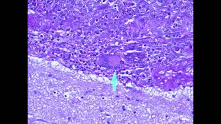 Giant Cell in Meninges trying to engulf a Cryptococcus PASX400 [upl. by Wiburg935]