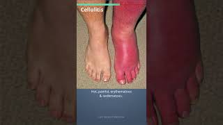 Learn in easy way about Cellulitis amp its treatment shorts [upl. by Suiramed]