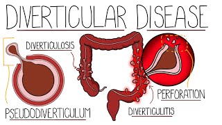 Understanding Diverticular Disease Diverticulosis and Diverticulitis [upl. by Chinua499]