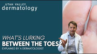 Whats Lurking Between the Toes  Utah Valley Dermatology [upl. by Jermain358]