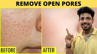 Remove Open Pores Very Fast Just 15mins Daily [upl. by Led]