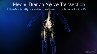 Endoscopic Medial Branch Nerve Transection [upl. by Alexia81]