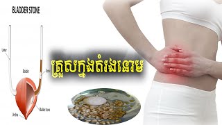 ជម្ងឺគ្រួសតម្រងនោម​  Lithiasis Renal or Calcul Renal [upl. by Asilec]