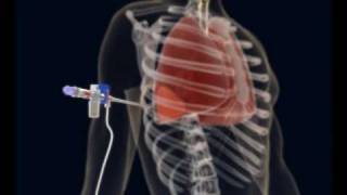 How to make a Thoracentesis pleural puncture with Pleurasafe [upl. by Girovard]