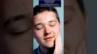 Chicken pox full detail  Treatment  symptoms chickenpox treatment viral virus disease health [upl. by Ehling]