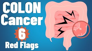 Colon cancer 6 EARLY symptoms amp why they occur  Colon cancer symptoms  colorectal cancer [upl. by Nrubliw]