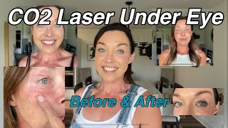 CO2 Under Eye Laser Treatment  Before During amp After [upl. by Artenra]