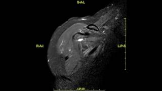 Perthes lesion of the shoulder  complete MRI examination [upl. by Coussoule]