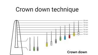 crown down technique  Easy explanation [upl. by Eidnim]