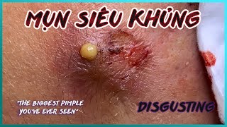 Big Cystic Acne Blackheads Extraction Blackheads amp Milia Whiteheads Removal Pimple Popping [upl. by Atinod845]