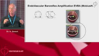 Podcase of the month quotMechanical baroreceptor stimulationquot preview [upl. by Buff]