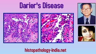 Pathology of Dariers Disease  Dr Sampurna Roy MD dermpath dermatopathology [upl. by Ayaet]