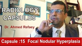 Capsule  15  Focal Nodular Hyperplasia [upl. by Yud913]