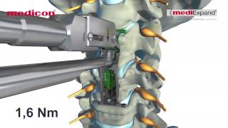 MEDICON  quotmediExpand®quot Cervical [upl. by Denyse]