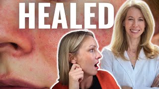 ROSACEA CAN BE HEALED Skin Flushing Blushing amp Erythrophobia with Dr Tara ODesky [upl. by Asiil658]