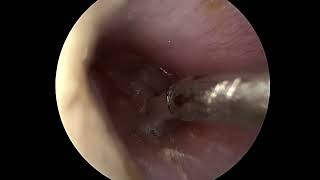 Ear tube placement myringotomy [upl. by Tibbetts]