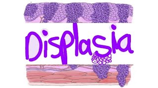 pathology Displasia and carcinoma in situ  intraepithelial carcinoma [upl. by Debbie]