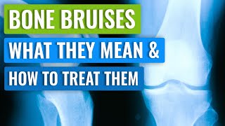 Bone Bruising in the Knee  Causes Symptoms and Treatment [upl. by Jovitta53]