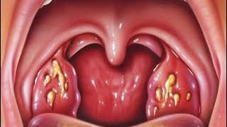 REMOVING TONSILS AND ADENOIDS [upl. by Enirtak]