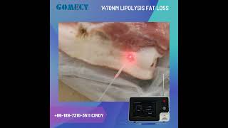 Does 1470nm laser really work for body lipolysis test this video to see how it is effective [upl. by Ford]