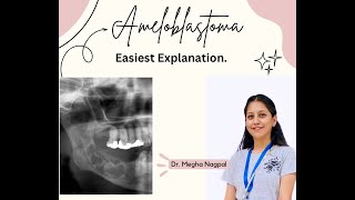 Ameloblastoma01  Easiest Explanation  Oral Pathology  BDS [upl. by Platto]