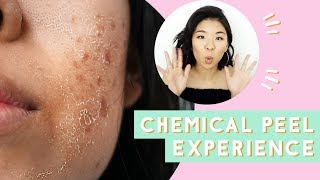 ✂ Chemical Peel for Acne amp Scars Before amp After [upl. by Hylan714]