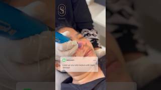 Skin analysis with micro needling 💗 skin shortsfeed [upl. by Mccallum]