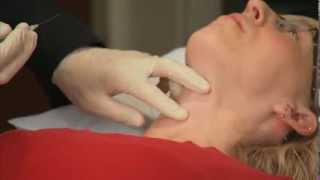 Laryngeal Botox Injection  Dr Ekbom at Mayo Clinic [upl. by Pomeroy483]