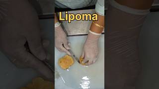 Lipoma histopathology biopsy humananatomy satisfying pathology humandevelopment tissue [upl. by Aimee]