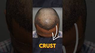 When to Remove Crust After Hair Transplant  Learn from the hair transplant surgeon  Dr Jangid [upl. by Onimixam]