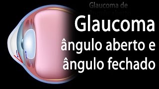 Desenvolvimento de Glaucoma Ângulo Aberto vs Ângulo Fechado Alila Medical Media Português [upl. by Nnodnarb]